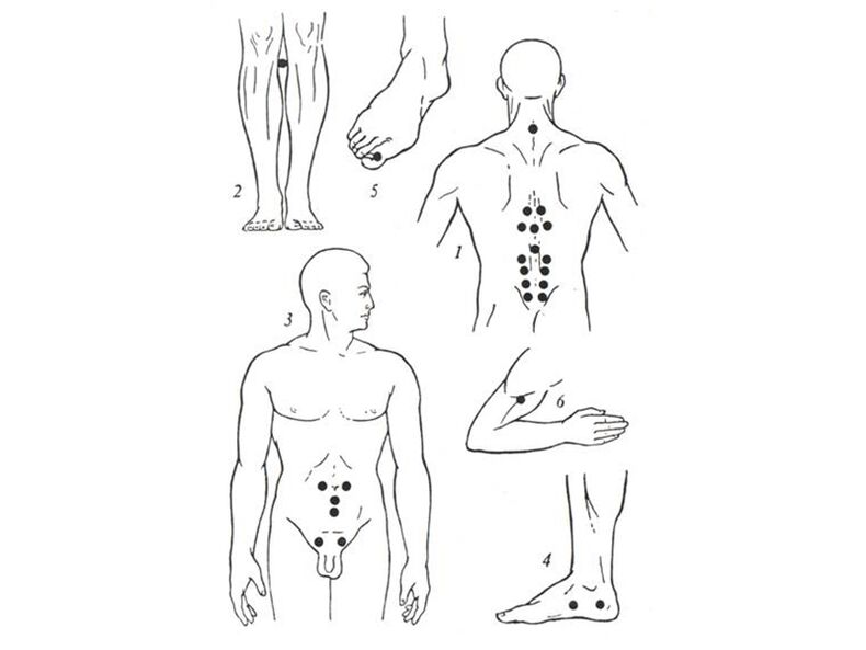 Acupuncture